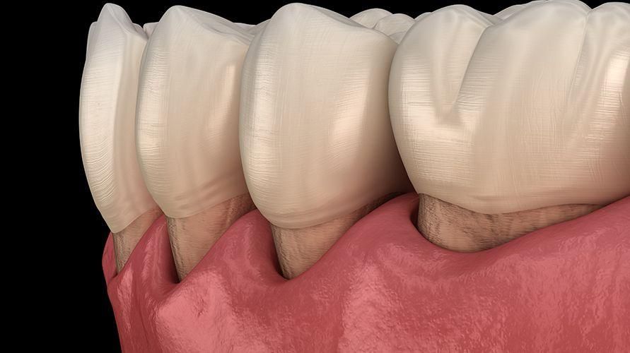 炎症を引き起こす脆弱性のある歯茎を下ろしますが、以前のように戻ることはできますか？
