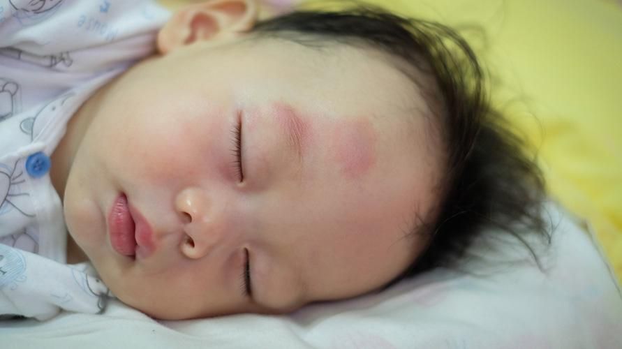 Bebeklerde Morlukları Panik Olmadan Aşmanın 5 Yolu