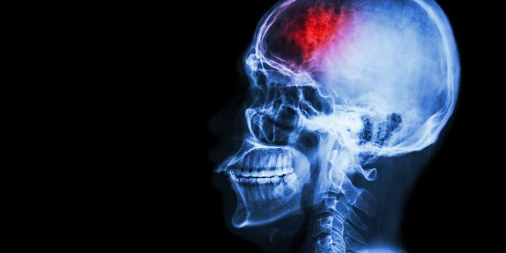 إصابات الدماغ ، إصابات الرأس التي تتلصص أثناء ممارسة الرياضة