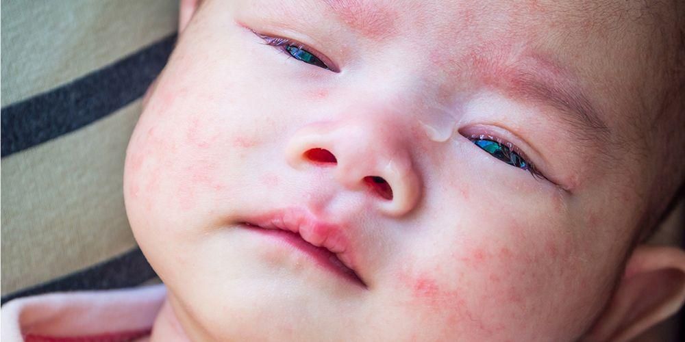 Bebeklerde Süt Alerjisi ve Laktoz İntoleransı Farklı Çıkıyor, İşte Nasıl Kontrol Edilir!