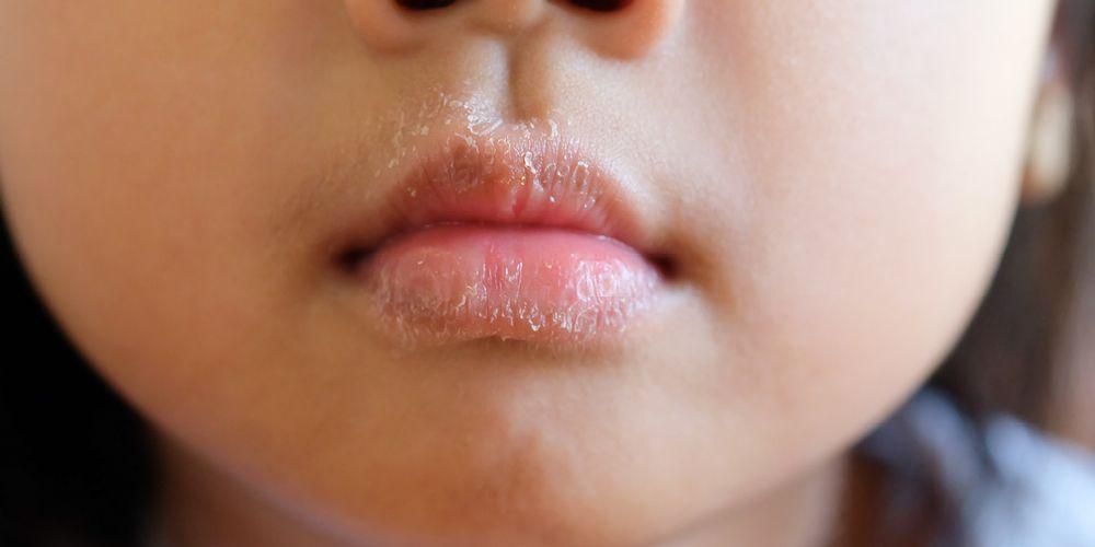 Kerap Mengalami Bibir Pecah? Waspadalah terhadap Bahaya Dermatitis di Bibir