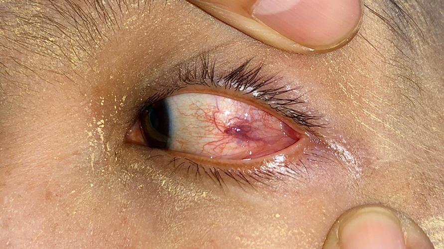 Инфекция с червеи Loa-Loa в окото, какво я причинява и как да се лекува?