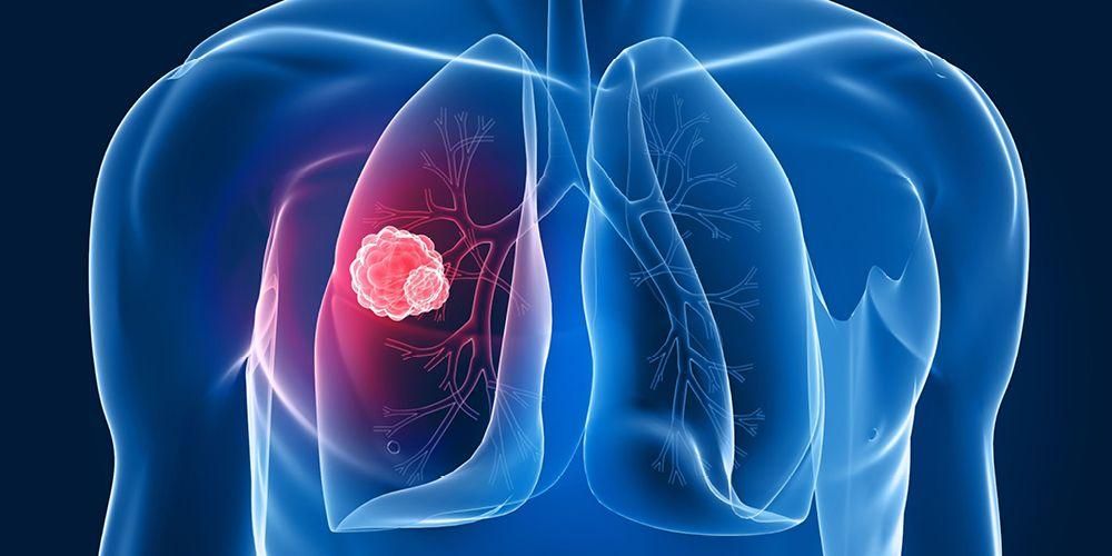 I tumori polmonari non sono sempre un segno di cancro ai polmoni, ecco la spiegazione