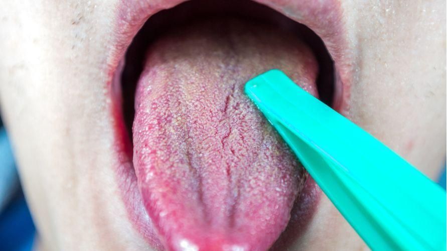 التعرف على داء المبيضات الفموي ، وهو عدوى فطرية تظهر في الفم