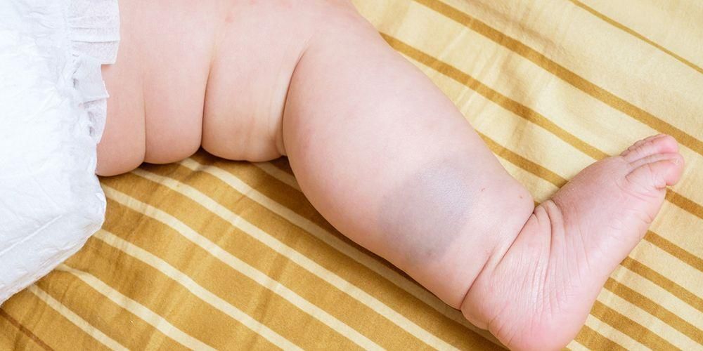 Ebeveynlerin Bilmesi Gereken Bebeklerdeki Doğum Lekesi Türleri
