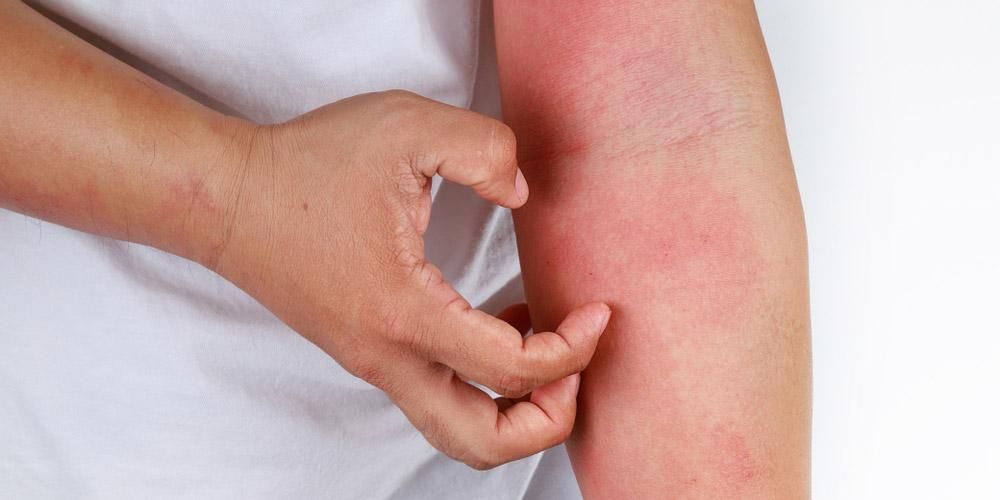 皮膚のかゆみや赤みを引き起こすアレルギー性接触皮膚炎を知る