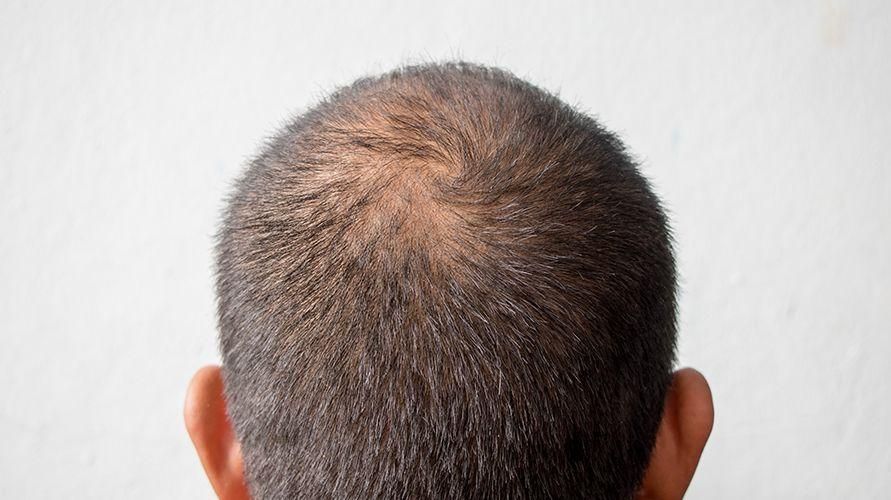 Melihat fungsi hormon DHT (Dihydrotestosteron) dan hubungannya dengan kebotakan rambut