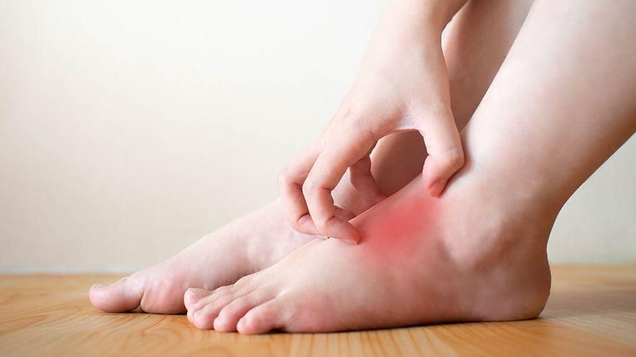 التعرف على التهاب الجلد في الركود والتهاب الجلد بسبب مشاكل الدورة الدموية في القدمين