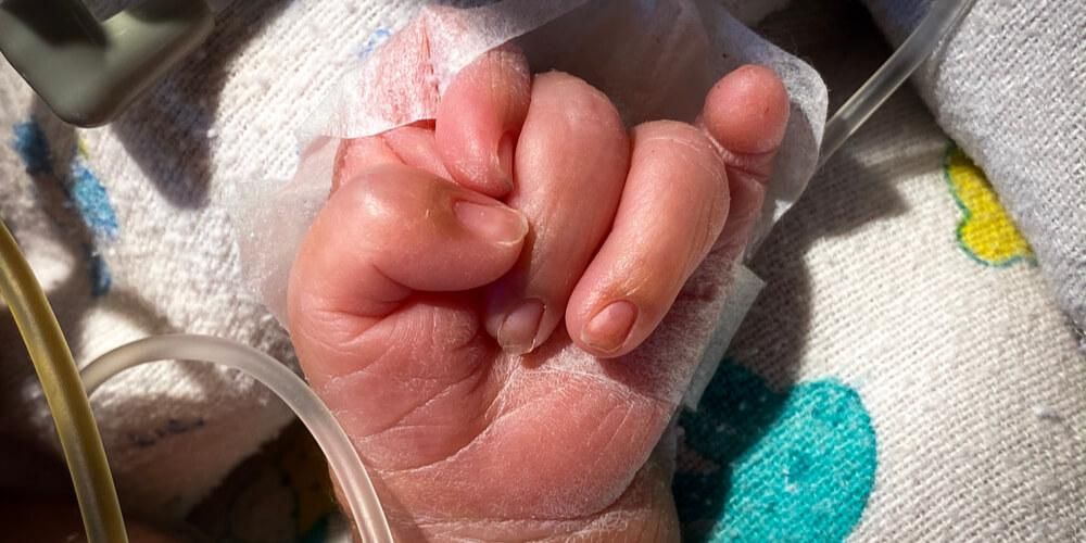 Mengetahui Sindrom Edward atau Trisomi 18 Yang Boleh Menyebabkan Kecacatan Kelahiran pada Bayi