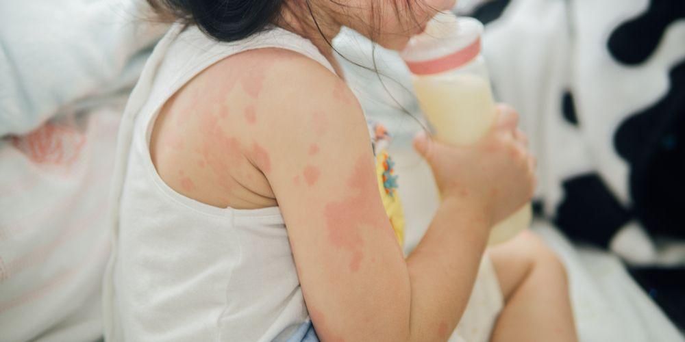 赤ちゃんの牛乳アレルギーの特徴、親は知っておくべきです！
