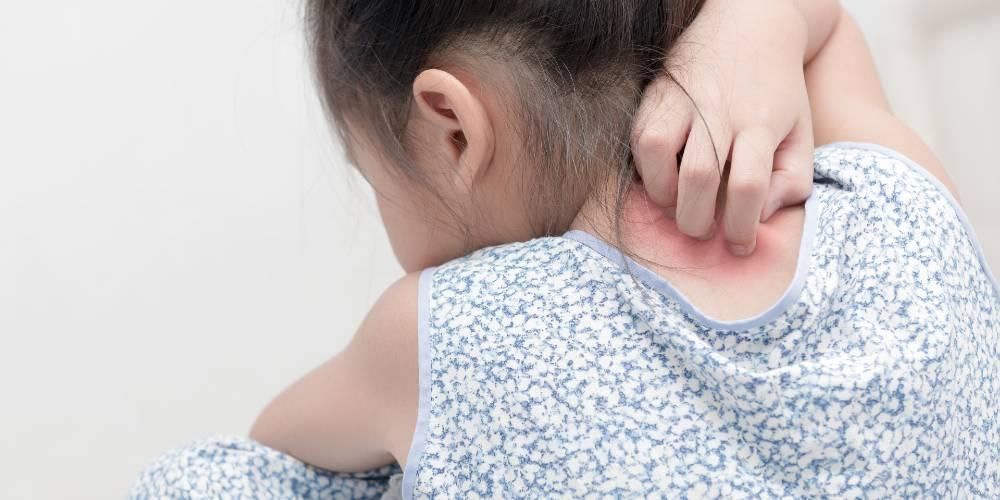 أعراض الجرب عند الأطفال الذين يعانون من أيام قليلة