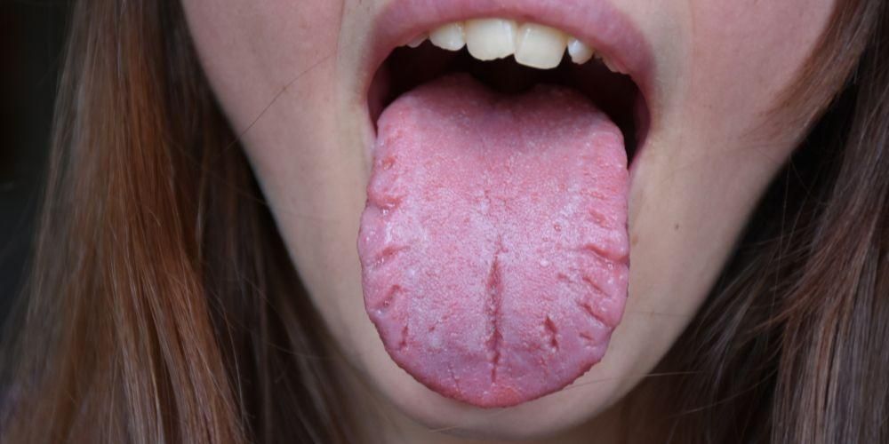 Jangan dipandang rendah, kenali keadaan lidah yang pecah dan cara mengatasinya