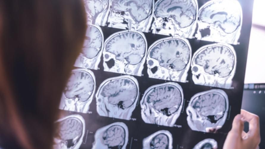 Мозъчна атрофия, медицинско състояние, което може да причини свиване на мозъка