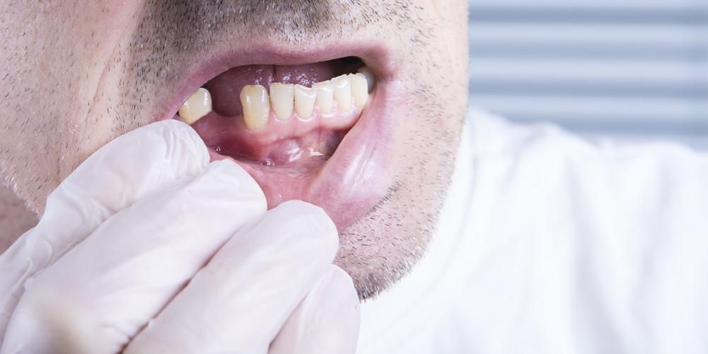 大人の歯の動揺の7つの原因