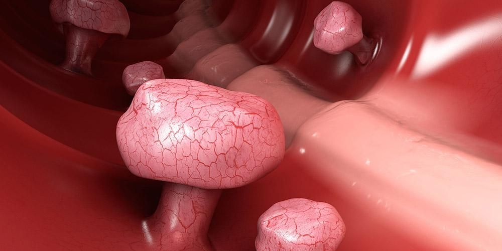 Spesso nessun sintomo, i polipi del colon-retto raramente diventano potenzialmente cancro