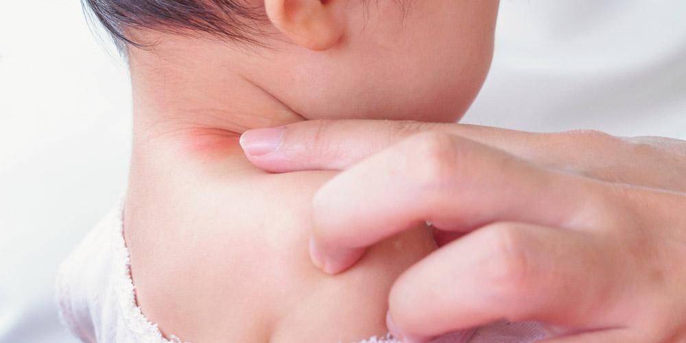 10 характеристики на лекарствената алергия при деца, които родителите трябва да знаят