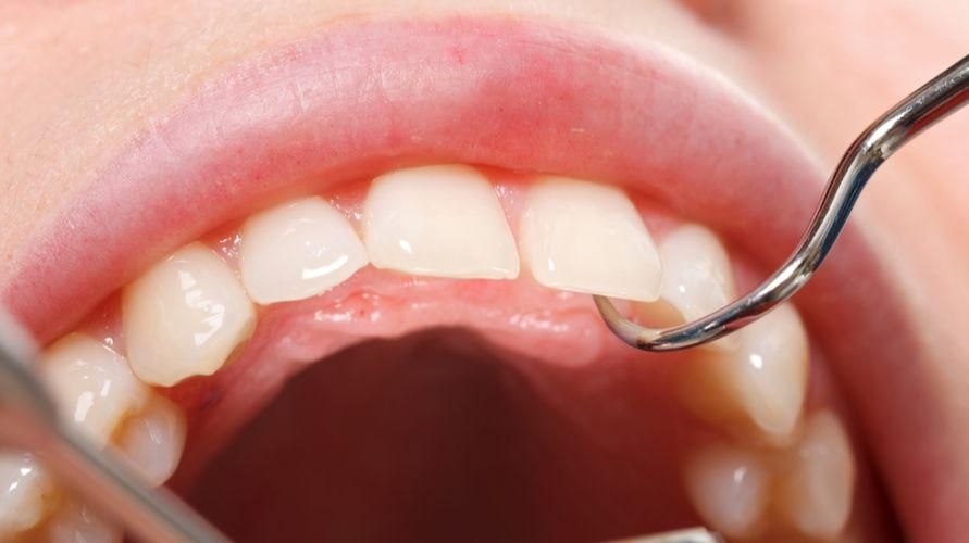 Hasarlı Diş Emayesinin Nedenleri ve Nasıl Önlenmesi ve Tedavisi