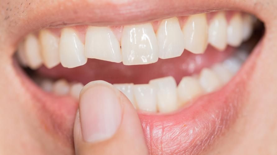 أسباب تشقق الأسنان وخيارات التغلب عليها