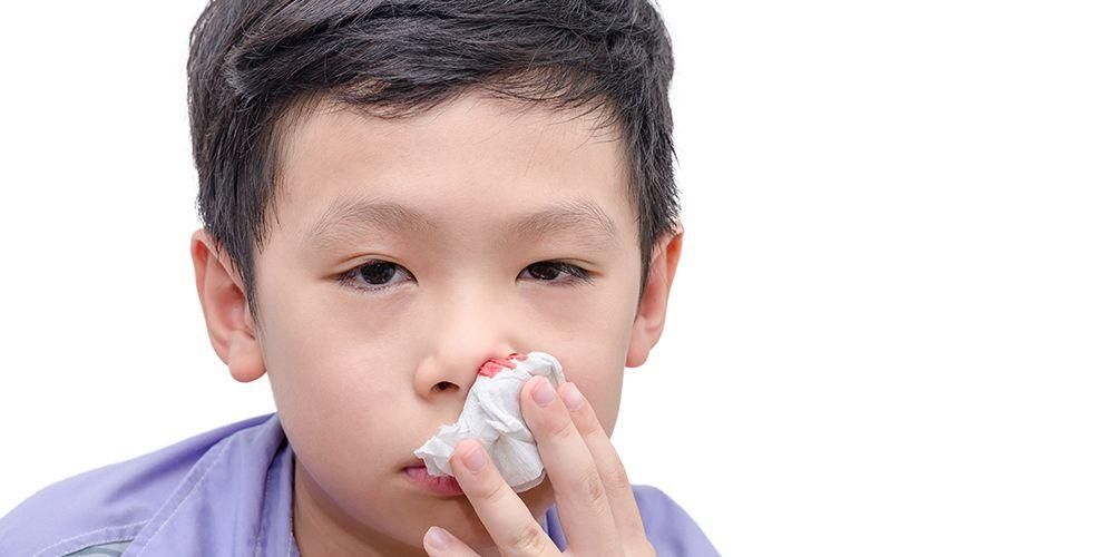 子供の鼻血を克服してすぐにやめる方法