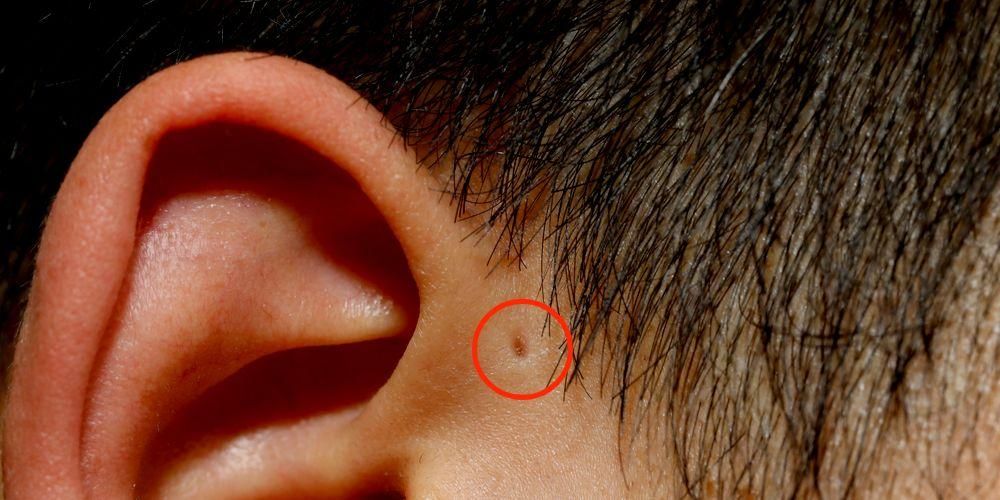 ثقب صغير في الأذن أو حفرة قبل الأذن ، خلقي غير ضار