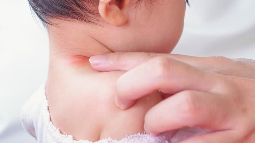 Lepuh Leher Bayi, Sebab Ini dan Cara Mengatasinya