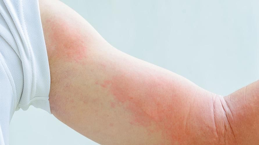 Fahami Punca Alergi Sejuk dan Cara Mengatasinya