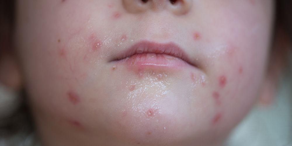 3 заболявания, причинени от този вирус, могат да атакуват кожата ви