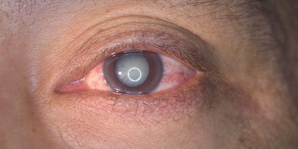 7 вида очни дефекти, от които трябва да се пазите