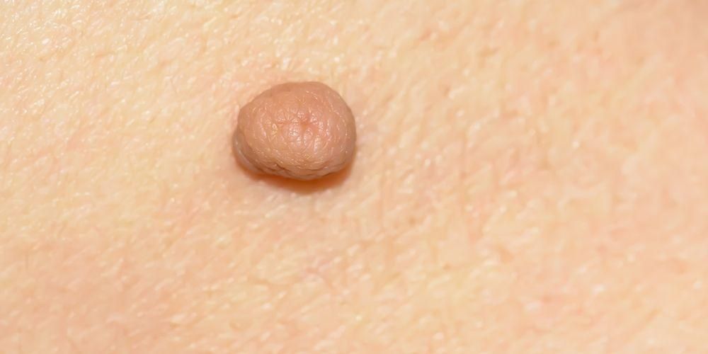 I tumori della pelle non sono sempre maligni, conosciamo il tipo
