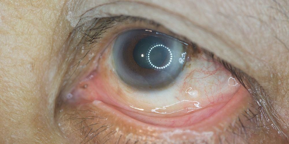 Остра глаукома: рискови фактори, симптоми и методи на лечение