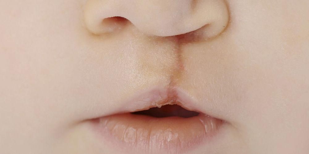 Labbro leporino nei bambini, può essere rilevato nell'utero