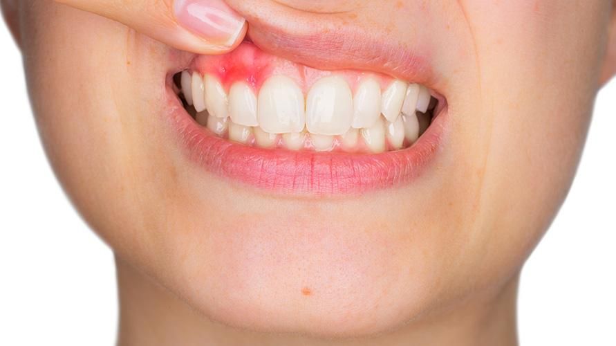 7 причини за сърбеж на венците, как да го преодолеем?