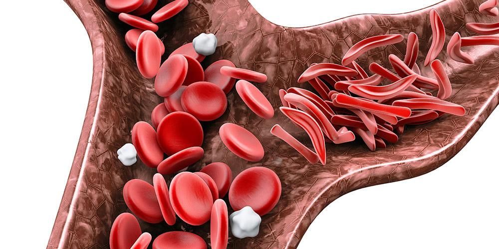 貧血の種類は、赤血球が少ないために発生します