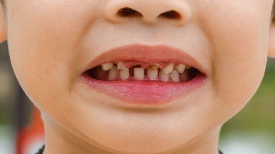 Cause della carie nei denti dei bambini e come trattarli correttamente