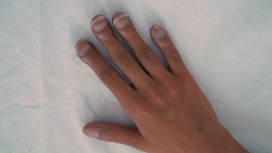 Причини за поява на пръсти или за нокти и как да се преодолее правилно