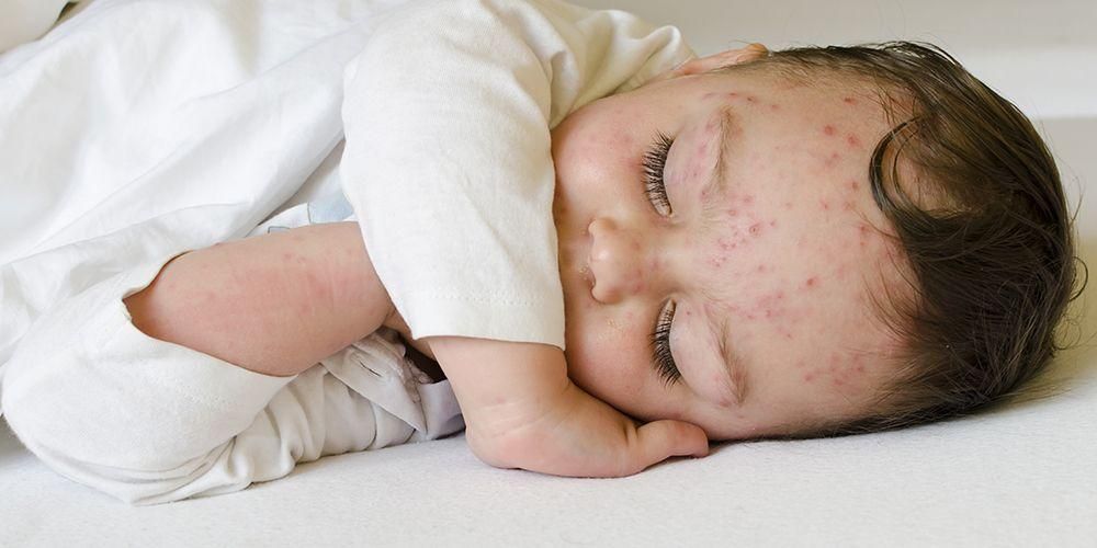 子供に安全で効果的な水痘の治療法