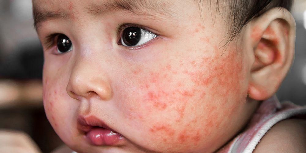 Разпознайте различните форми на алергии при деца и как да ги лекувате