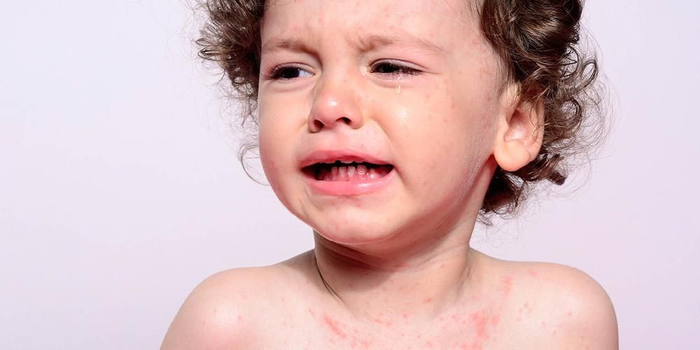 Симптоми на морбили при деца, за които родителите трябва да внимават
