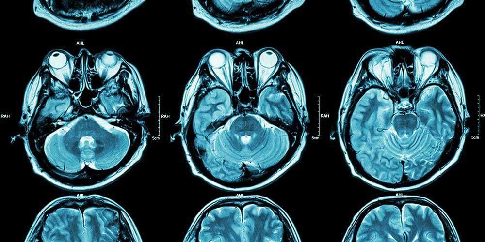 Beyin Hasarının Bilinmesi Gereken Giriş ve Çıkışları