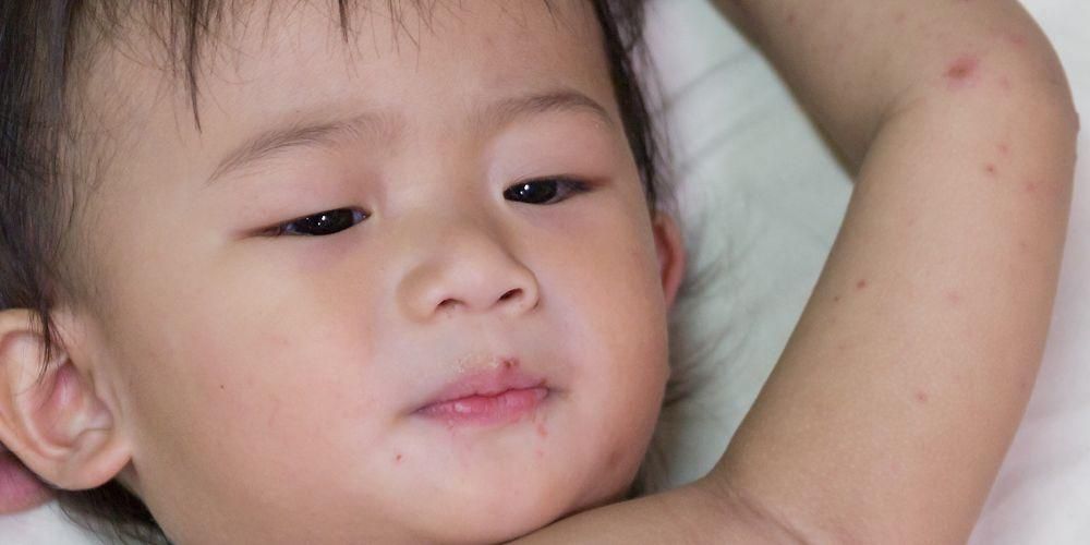 Херпес при бебета, разпознаване на симптомите и как да се лекува