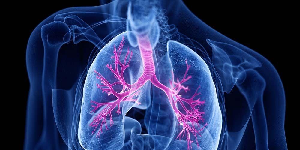 Spesso associata alla fibrosi cistica, la bronchiectasia è un danno ai bronchi