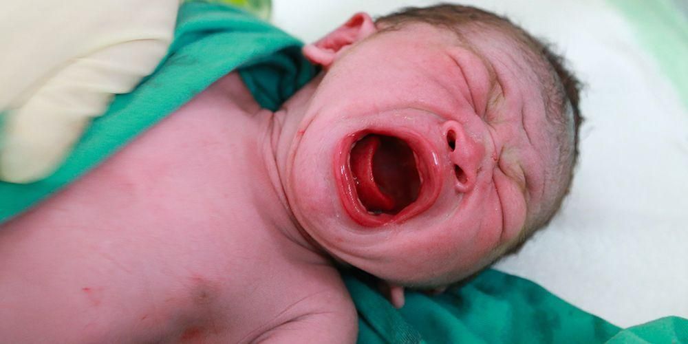 Sirenomelia, Sindrom Duyung Ketika Bayi Lahir Bersama Kaki