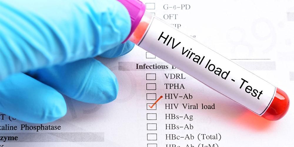 Познаване на вирусното натоварване с ХИВ при измерване на количеството на вируса в тялото на пациента