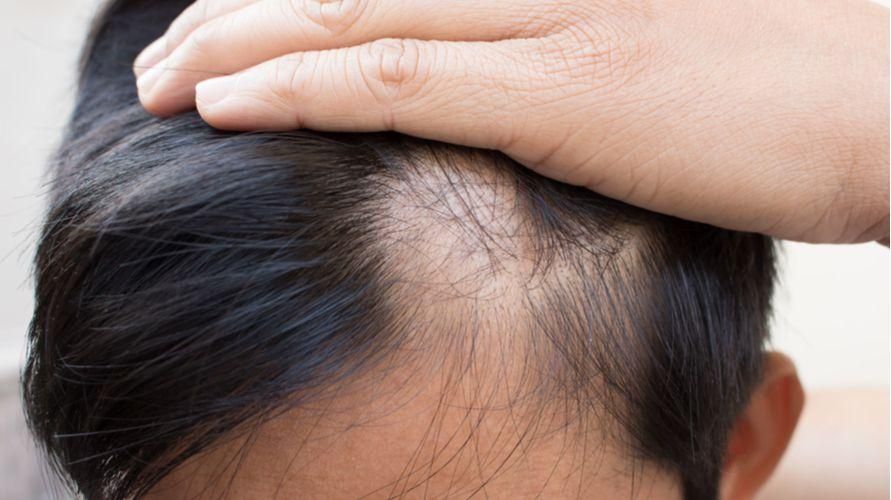 8 cause della caduta dei capelli nei bambini e come superarla
