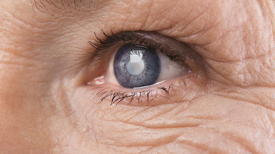 تعرف على خصائص إعتام عدسة العين الشائعة لدى كبار السن