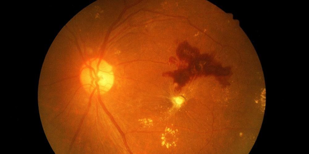 Eylea, una nuova opzione nel trattamento della retinopatia diabetica