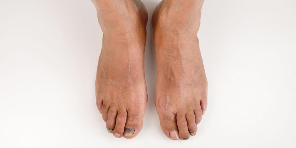 นิ้วเท้าโควิด อาการใหม่ ของโควิด-19 ในรูปแบบของรอยสีม่วงบนเล็บเท้า